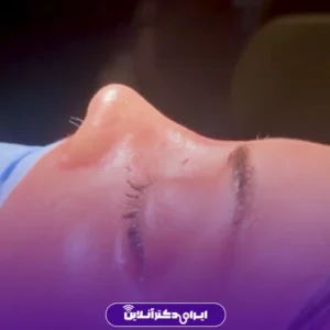 نمونه کار عمل بینی دکتر محمد مهدی طرزی 1