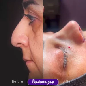 نمونه کار عمل بینی دکتر محمد مهدی طرزی 3
