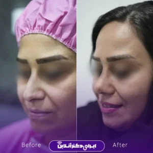 نمونه کار عمل بینی دکتر نجمه برخورداری 10