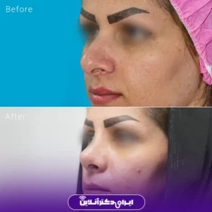 نمونه کار عمل بینی دکتر نجمه برخورداری 2