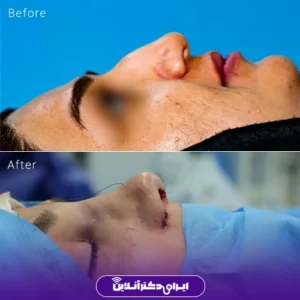 نمونه کار عمل بینی دکتر نجمه برخورداری 3
