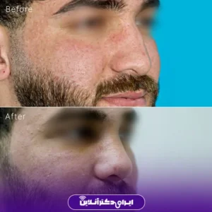 نمونه کار عمل بینی دکتر نجمه برخورداری 5