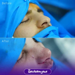 نمونه کار عمل بینی دکتر نجمه برخورداری 6