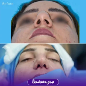 نمونه کار عمل بینی دکتر نجمه برخورداری 7