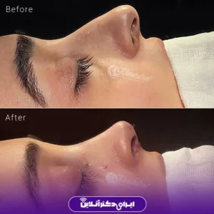 نمونه کار جراحی بینی دکتر شاهرخ خوش سیرت