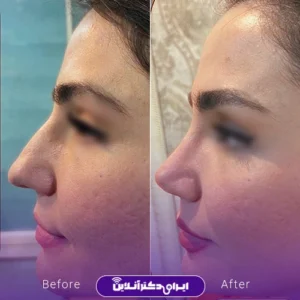 نمونه کار قبل و بعد عمل بینی گوشتی خانم توسط دکتر منصور توفیقی زواره