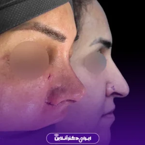 نمونه عمل بینی دکتر شهاب خسروی 2