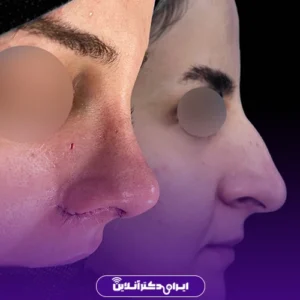 نمونه عمل بینی دکتر شهاب خسروی 4