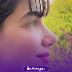 نمونه عمل بینی دکتر شهاب خسروی 7