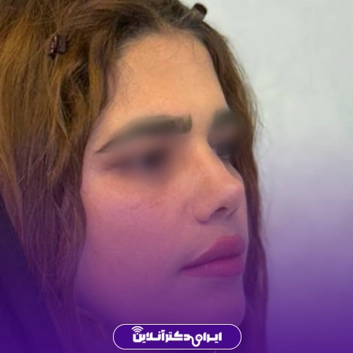 بهترین جراح بینی گوشتی در تهران + معرفی 20 پزشک برتر 66 نمونه جراحی بینی گوشتی دکتر یوسف شفایی 1