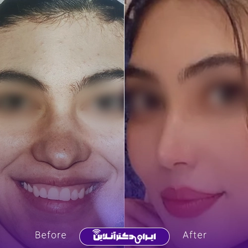 بهترین جراح بینی گوشتی در تهران + معرفی 20 پزشک برتر 52 نمونه عمل بینی گوشتی دکتر حمیدرضا راستی بروجنی 2
