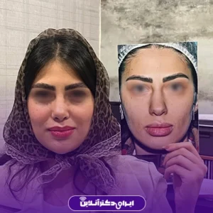 نمونه کار قبل و بعد عمل بینی گوشتی خانم‌ها دکتر شایسته شهمیرزادی در شهر کرج