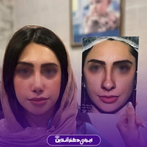 نمونه عمل بینی گوشتی خانم دکتر شایسته شهمیرزادی