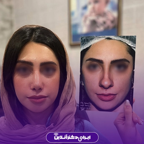 نمونه عمل بینی گوشتی خانم دکتر شایسته شهمیرزادی