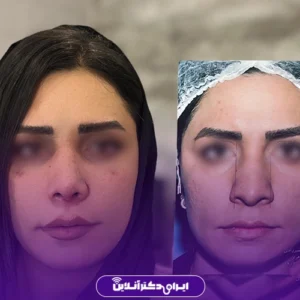نمونه کار جراحی بینی گوشتی نمای روبه‌رو توسط دکتر شایسته شهمیرزادی
