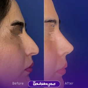 نمونه کار عمل بینی دکتر حسن هنرور اسدالهی 1