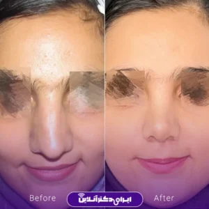 نمونه کار عمل بینی دکتر حسن هنرور اسدالهی 10