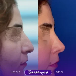 نمونه کار عمل بینی دکتر حسن هنرور اسدالهی 2