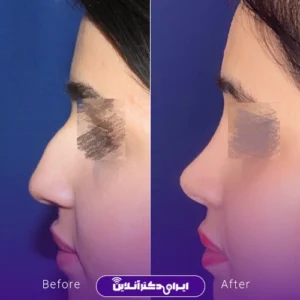 نمونه کار عمل بینی دکتر حسن هنرور اسدالهی 3
