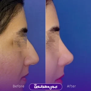 نمونه کار عمل بینی دکتر حسن هنرور اسدالهی 4