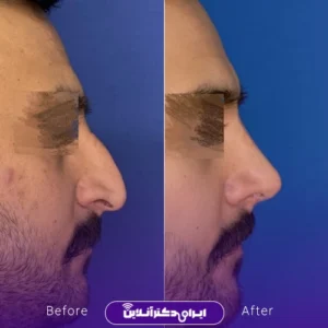 نمونه کار عمل بینی دکتر حسن هنرور اسدالهی 5