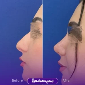 نمونه کار عمل بینی دکتر حسن هنرور اسدالهی 8