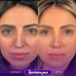 نمونه کار عمل بینی دکتر احمدرضا رجایی 1