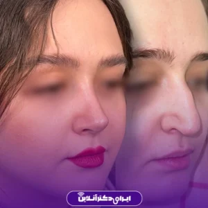نمونه کار عمل بینی دکتر احمدرضا رجایی 3
