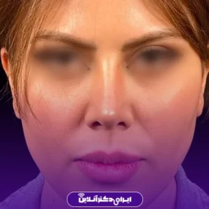 نمونه کار عمل بینی دکتر احمدرضا رجایی 4