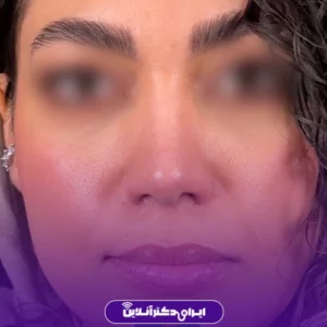 نمونه کار عمل بینی دکتر احمدرضا رجایی 5
