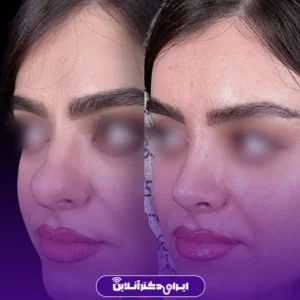 نمونه کار عمل بینی دکتر احمدرضا رجایی 6