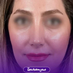 نمونه کار عمل بینی دکتر احمدرضا رجایی 8