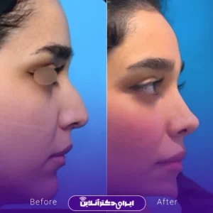 نمونه کار عمل بینی دکتر علیرضا محبی 2