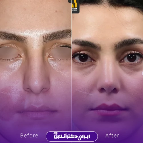 بهترین جراح بینی گوشتی در تهران + معرفی 20 پزشک برتر 69 نمونه کار عمل بینی دکتر علیرضا محبی 4