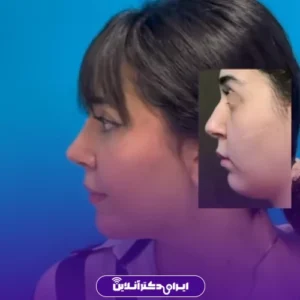 نمونه کار عمل بینی دکتر علیرضا محبی 5