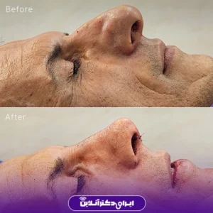 نمونه کار عمل بینی دکتر محمد مهدی مهرابی 1