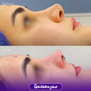 نمونه کار عمل بینی دکتر محمد مهدی مهرابی 3
