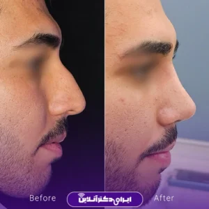 نمونه کار عمل بینی دکتر محمد مهدی مهرابی 4