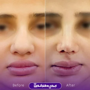 نمونه کار عمل بینی دکتر محمد مهدی مهرابی 5