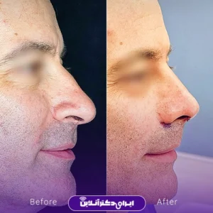 نمونه کار عمل بینی دکتر محمد مهدی مهرابی 6