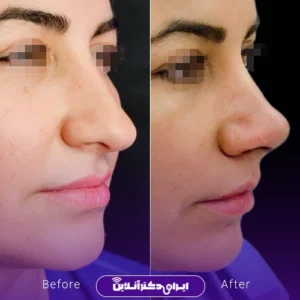 نمونه کار عمل بینی دکتر محمد مهدی مهرابی 8