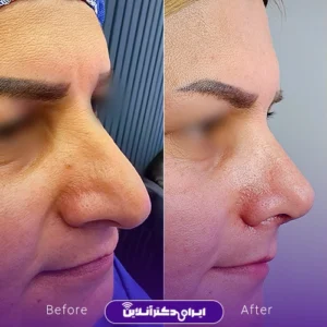 نمونه کار عمل بینی دکتر محمد مهدی مهرابی 9