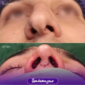 نمونه کار عمل بینی دکتر سید محسن فانی 1