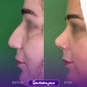 نمونه کار عمل بینی دکتر سید محسن فانی 2