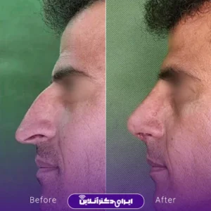 نمونه کار عمل بینی دکتر سید محسن فانی 3