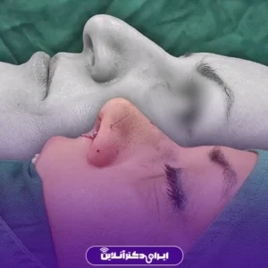 نمونه کار عمل بینی دکتر سید محسن فانی 4