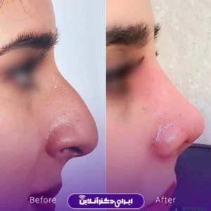 نمونه کار عمل بینی دکتر سید محسن فانی 5
