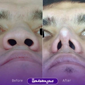 نمونه کار عمل بینی دکتر سید محسن فانی 6