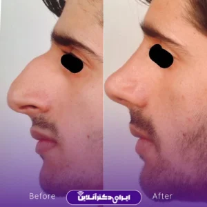 نمونه کار عمل بینی دکتر سید محسن فانی 8