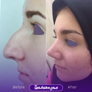 نمونه کار عمل بینی دکتر سید محسن فانی 9